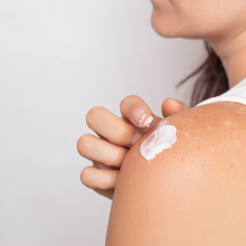 vrouw die pigment crème aanbrengt op schouder