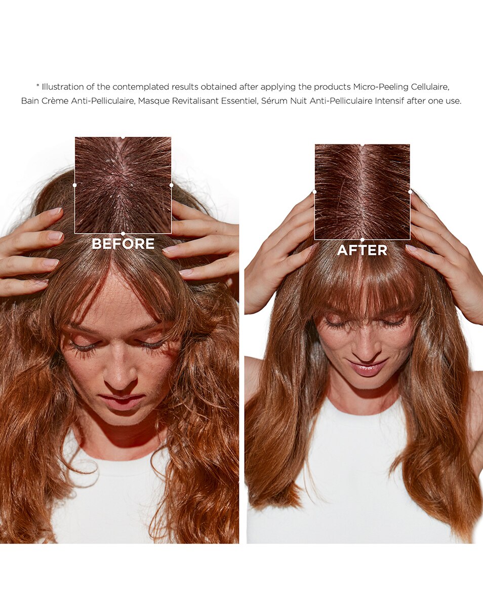 Soin Anti-Pelliculaire Intense