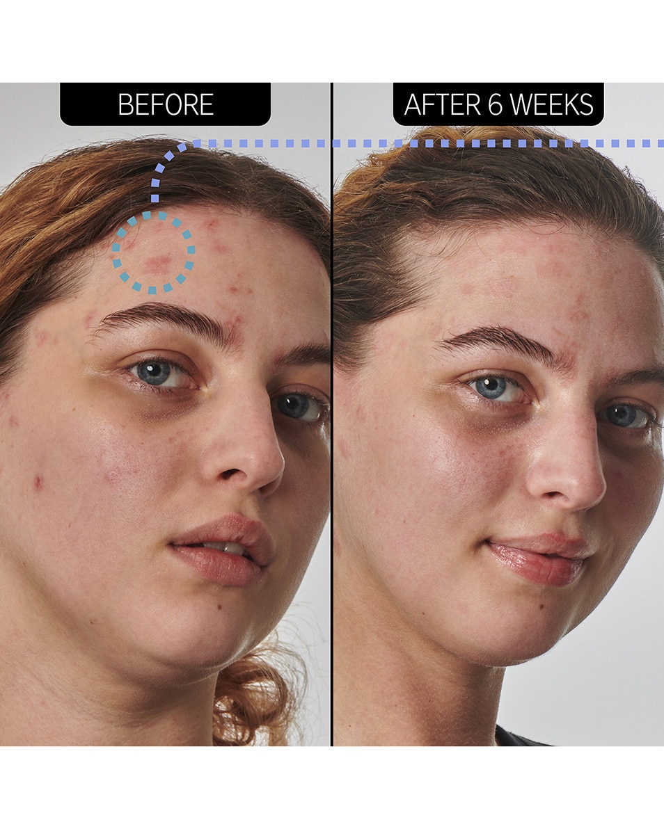 HYDRATANT 10 % URÉE