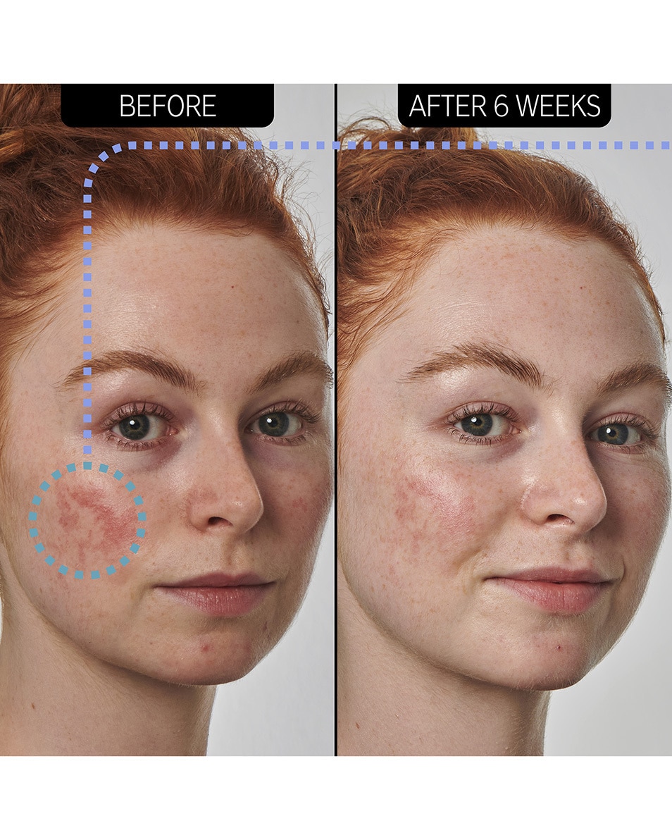 SUPERSOLUTIONS 10% AZELAIC ACID SERUM