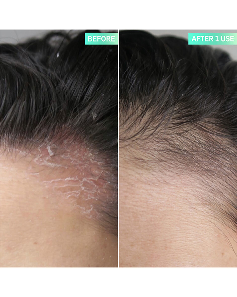 The Inkey List HAIRCARE SOIN CUIR CHEVELU EXFOLIANT À L'ACIDE SALICYLIQUE 150 ML 3