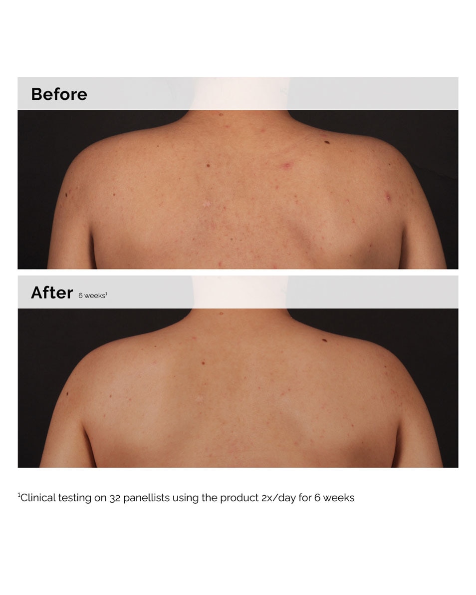 THE ORDINARY SIGNS OF CONGESTION SÉRUM CORPS À L'ACIDE SALICYLIQUE 0.5% 240 ML 3