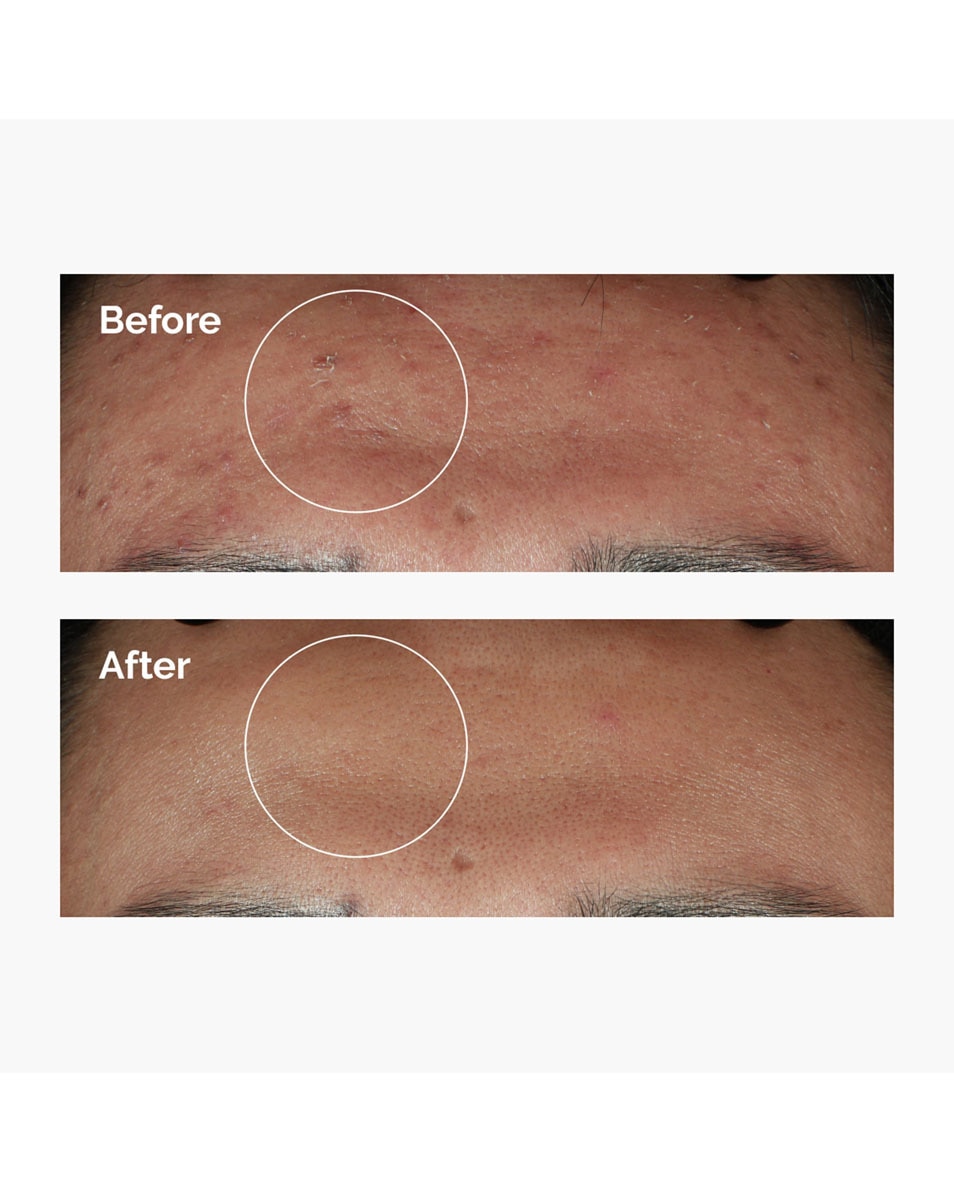 Niacinamide 10% + Zinc 1%