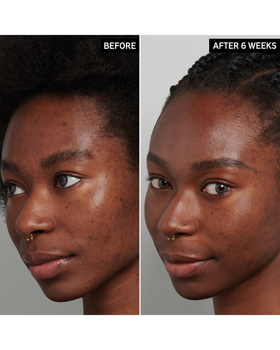 SOIN À L'ACIDE TRANEXAMIQUE