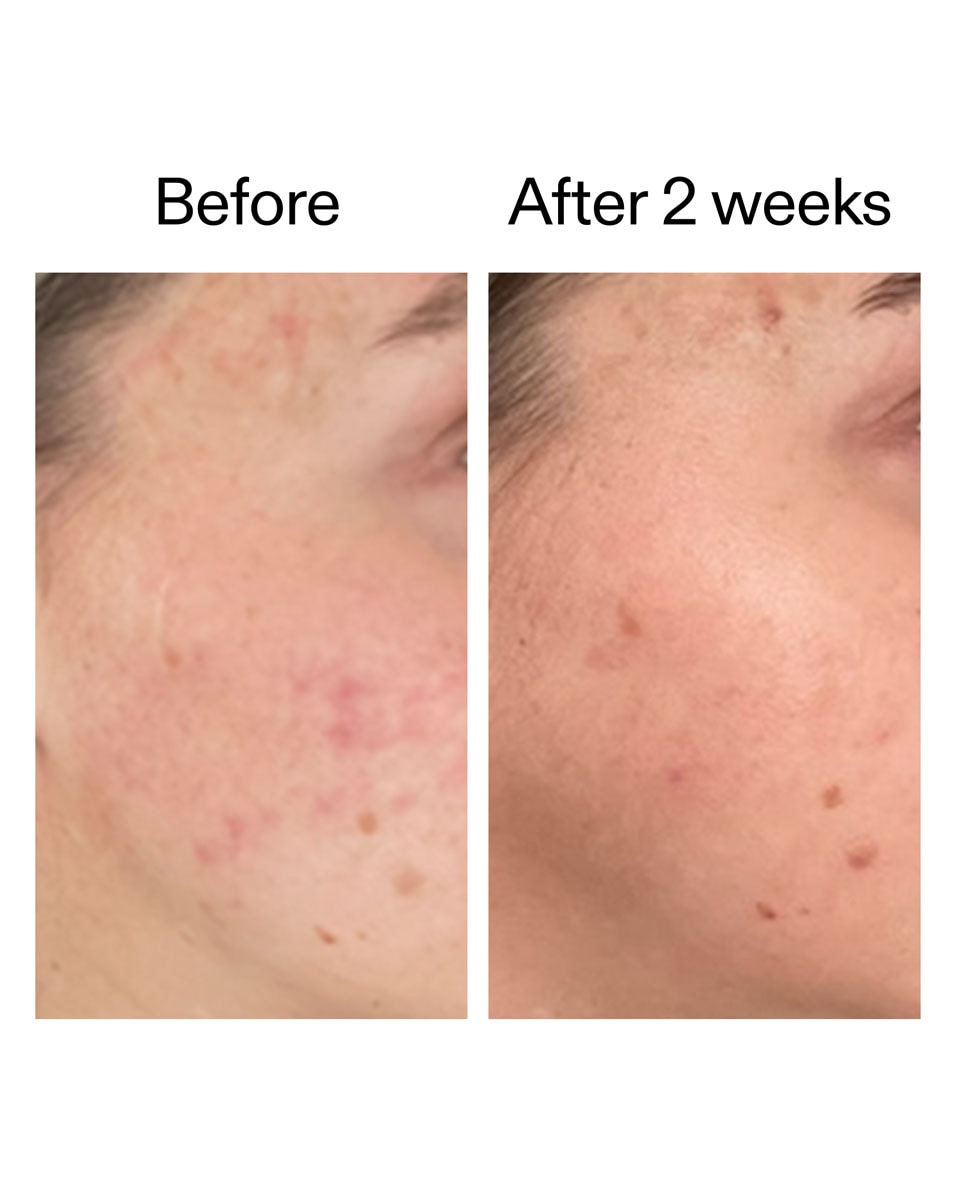 Barrière Huidverzorgingsset