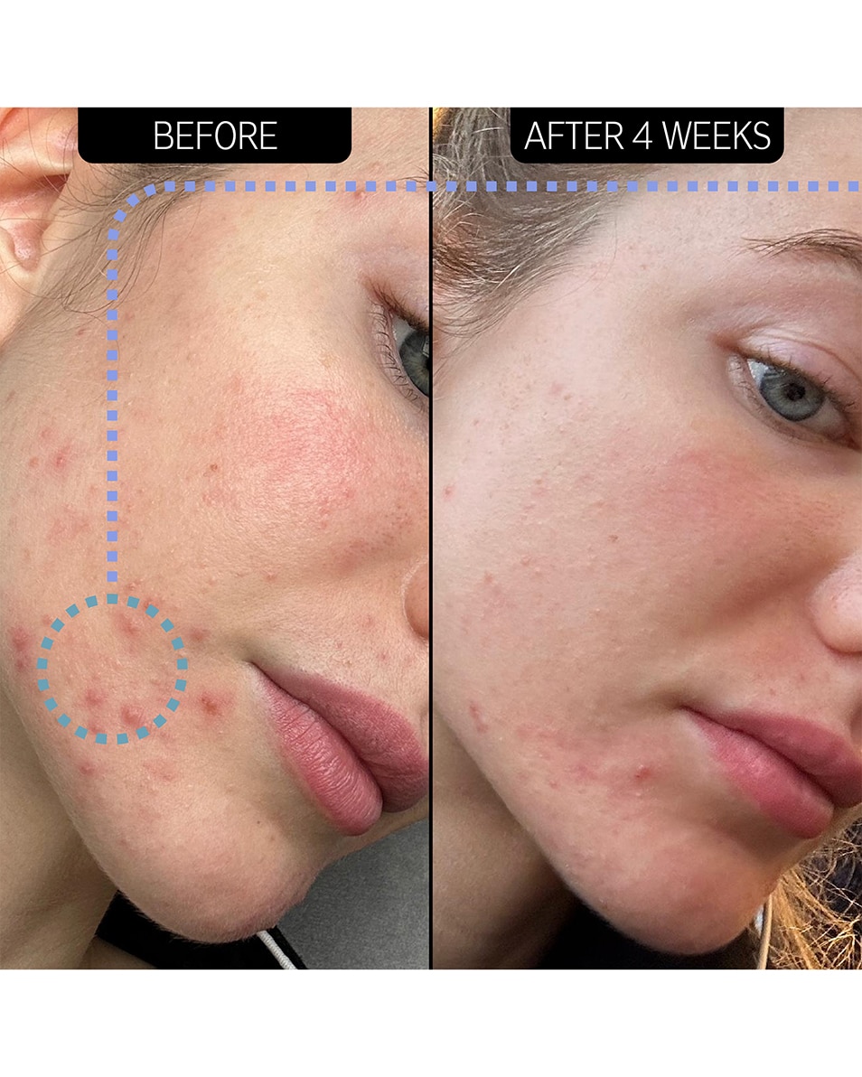 SOIN HYDRATANT ANTI-IMPERFECTIONS AVEC 2 % DE NOVORETIN