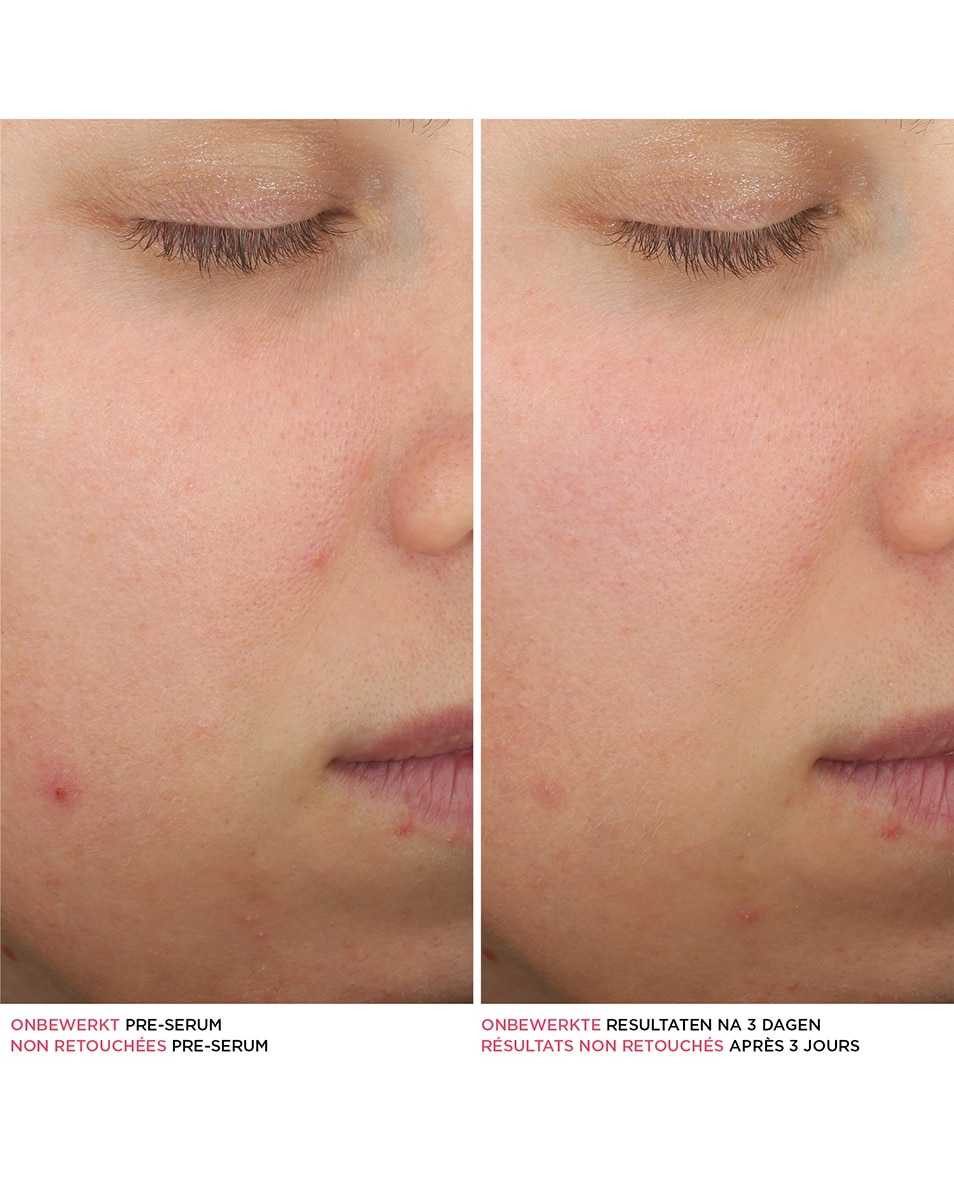 BYE BYE BREAKOUT SERUM