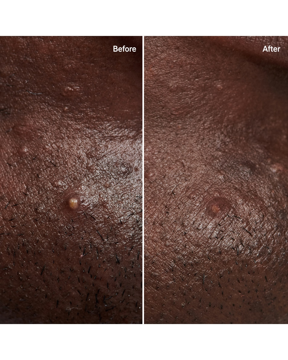 Hydrocolloïde pleisters voor onzichtbare puistjes